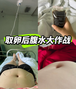 试管取卵后腹水大作战，希望下个月能顺利移植