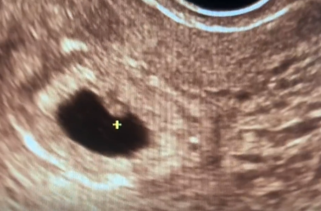 b6774021066afcc31827b936e2ebb688.png 二移好不容易着床,孕七周阴超竟然三无