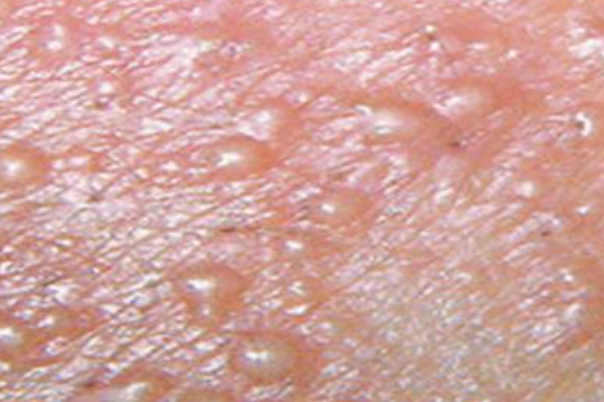 2728137b9d1255d0706369b002837b07.png 梅毒图片