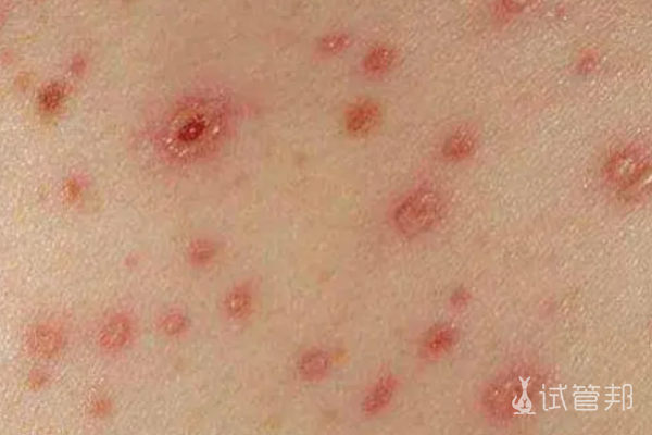 38b0bfafd4e84d15f3480b10d8032b0e.png 梅毒能治好吗