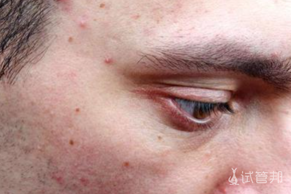 41ef1d27302d320ce89a3e2a106d5e64.png 梅毒的治疗方式有哪些