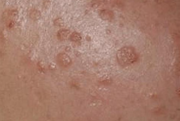 74b1e14c337cecba836b370fc05c6503.png 梅毒是怎么传染的