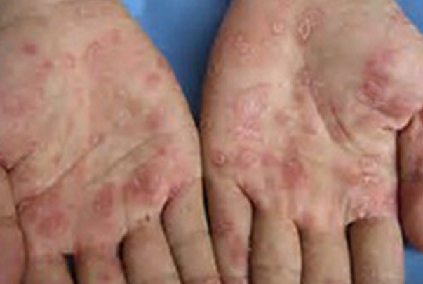 9e463f3816eca51e1d0b43dc32ae4fa0.png 梅毒的潜伏期一般多久发作