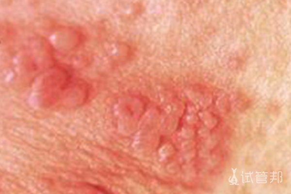 c578d9231a5deb86bdec0f17442e9cad.png 梅毒早期症状有哪些