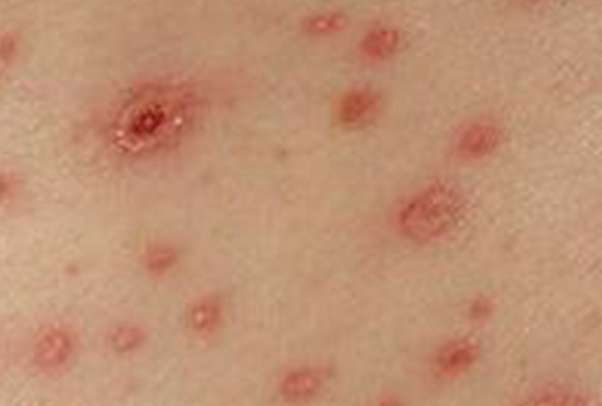 f84f6aca8249c11c85c0ffd9305415ea.png 梅毒的症状和图片