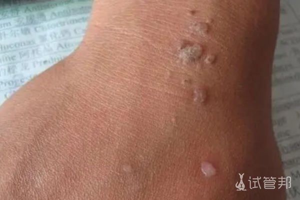 97a00760ba4c697e7348d3298aa688d2.png 梅毒症状有哪些