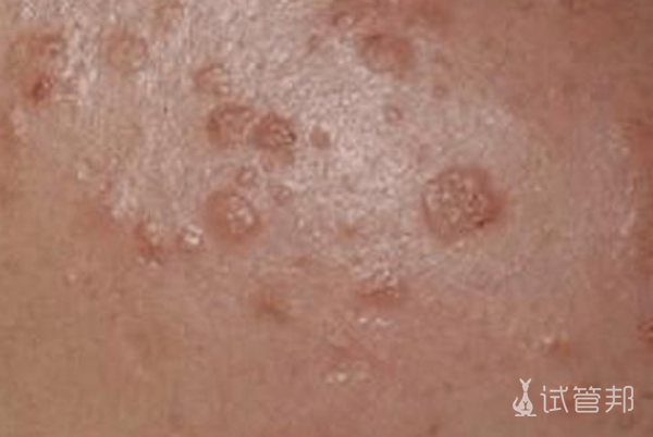 a1d0c36a5a5e002c15c694f7d1037526.png hpv是艾滋病吗