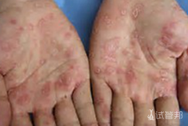 f7ef6a9ffe4977ccbf2fa3f393761cc4.png 艾滋病皮肤症状图片