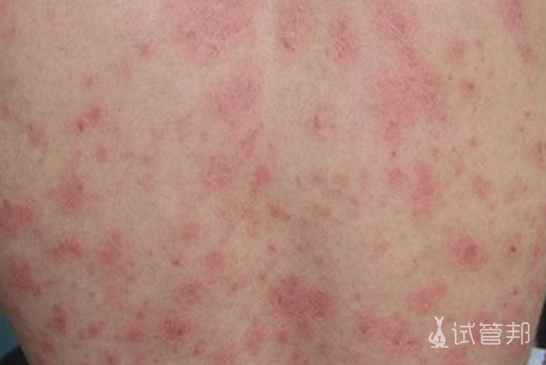 69ebefb45c8d7e191daa469ff9eb568d.png 艾滋病能治愈吗