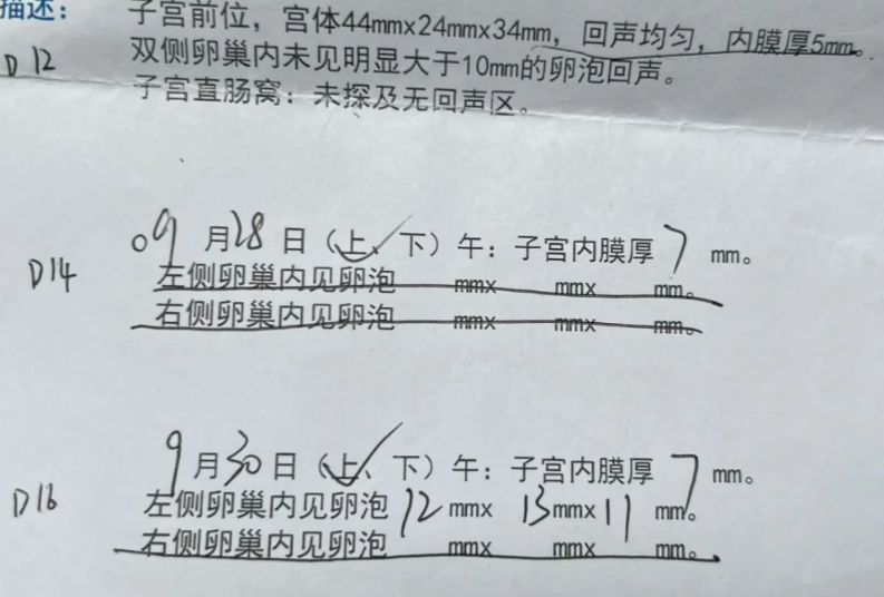 多囊促排全记录两年弯路后终于找对方法