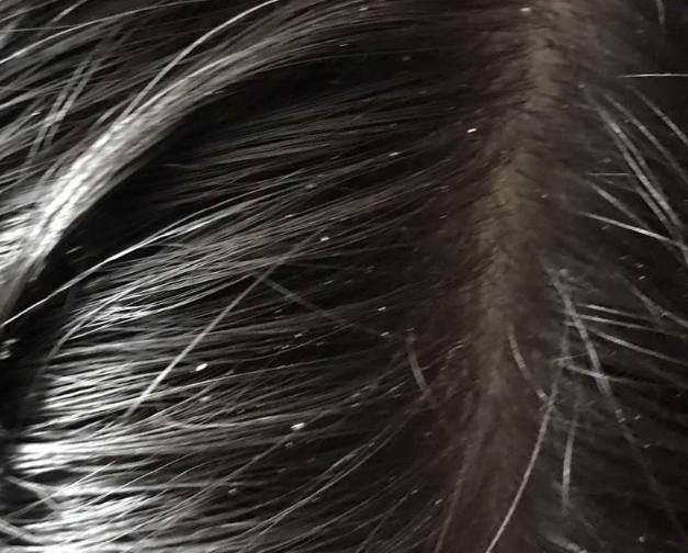 移植后5天没洗的头皮老公看了一眼当场yue了