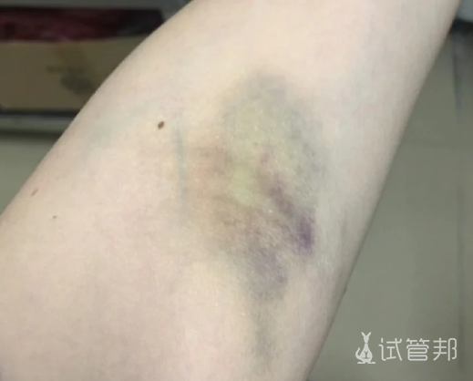 edce49135be39c4ca15a6de06f456e5c.png 抽血抽到胳膊青紫